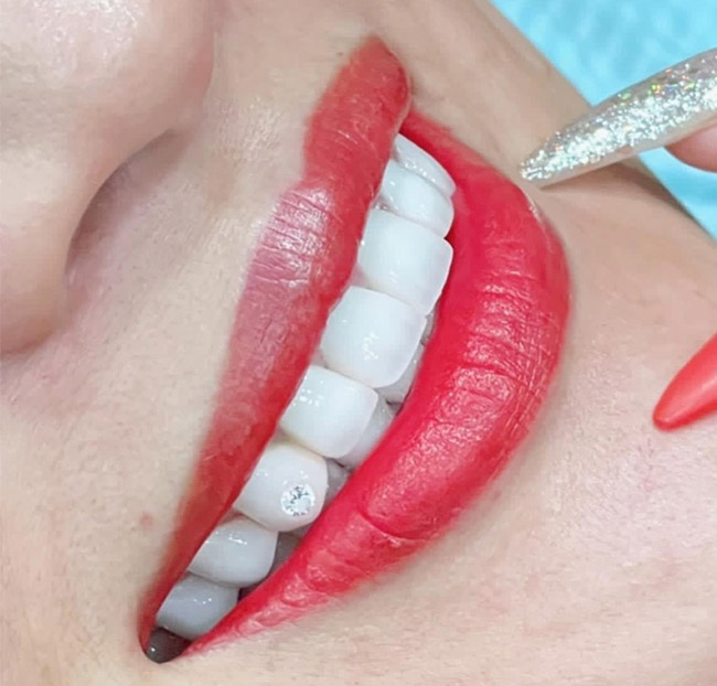 White Smile Dental - Trám Răng Công Nghệ Thẩm Mỹ Cao Cấp. Voucher 500,000 VNĐ, Còn 99,000 VNĐ, Giảm 80%. Chỉ Có Tại Hotdeal.vn!