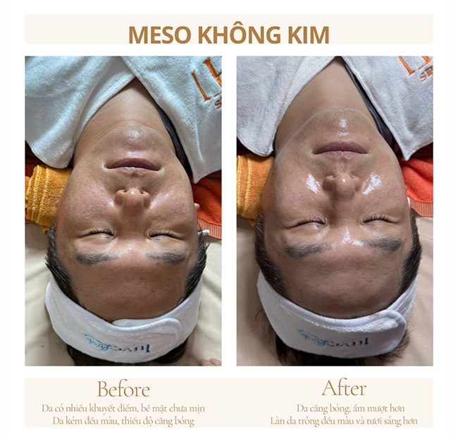 LHALA# Spa & Salon - Nhuộm + Phục Hồi/ Meso Không Kim/ Chăm Sóc Da Đầu. Voucher 1,200,000 VNĐ, Còn 299,000 VNĐ, Giảm 75%. Chỉ Có Tại Hotdeal.vn!