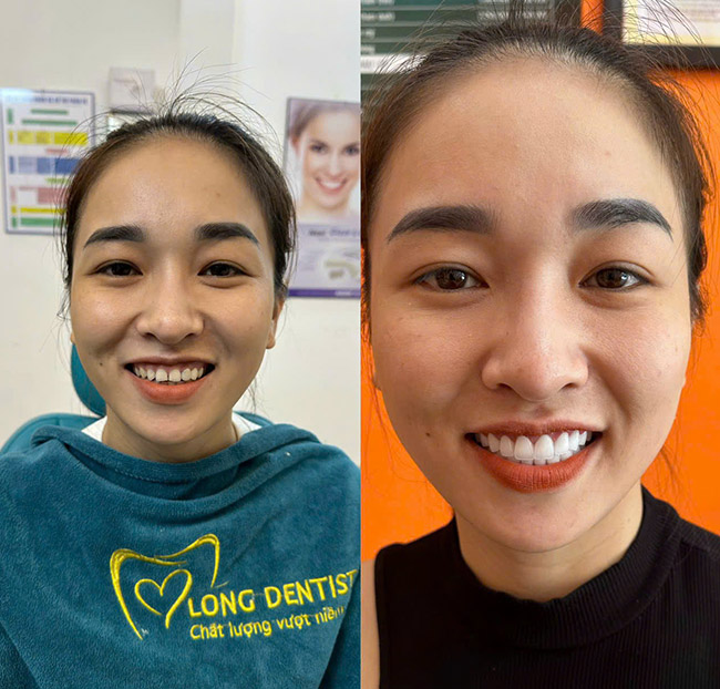 Nha Khoa Kim Long - Răng Toàn Sứ Zirconia - Bảo Hành Trọn Đời. Voucher 3,000,000 VNĐ, Còn 1,190,000 VNĐ, Giảm 60%. Chỉ Có Tại Hotdeal.vn!