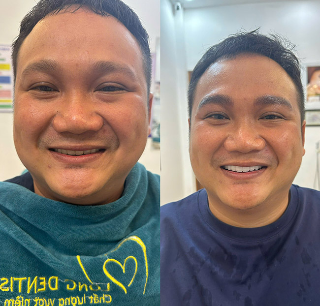 Nha Khoa Kim Long - Răng Toàn Sứ Zirconia - Bảo Hành Trọn Đời. Voucher 3,000,000 VNĐ, Còn 1,190,000 VNĐ, Giảm 60%. Chỉ Có Tại Hotdeal.vn!