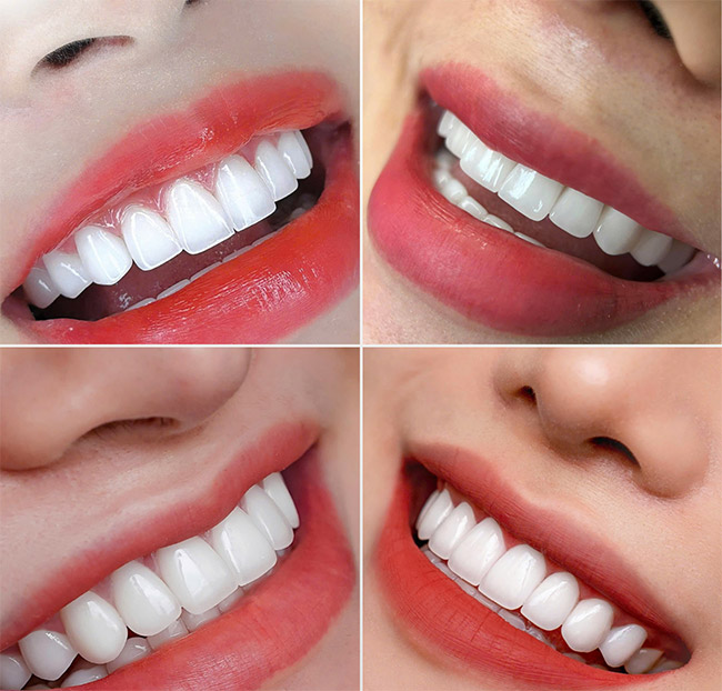 Nha Khoa Kim Long - Răng Toàn Sứ Zirconia - Bảo Hành Trọn Đời. Voucher 3,000,000 VNĐ, Còn 1,190,000 VNĐ, Giảm 60%. Chỉ Có Tại Hotdeal.vn!