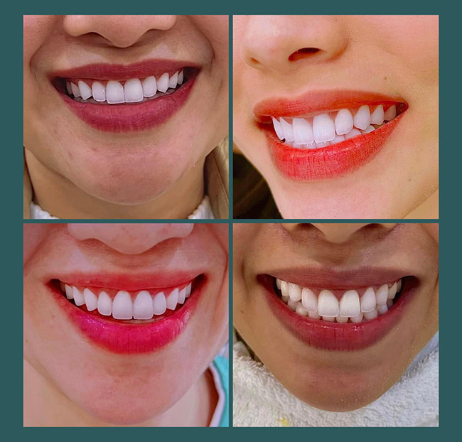 Nha Khoa Kim Long - Răng Toàn Sứ Zirconia - Bảo Hành Trọn Đời. Voucher 3,000,000 VNĐ, Còn 1,190,000 VNĐ, Giảm 60%. Chỉ Có Tại Hotdeal.vn!