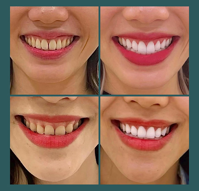 Nha Khoa Kim Long - Điều Trị Nha Chu/Nhổ/Trám Răng/Tẩy Trắng. Voucher 300,000 VNĐ, Còn 69,000 VNĐ, Giảm 77%. Chỉ Có Tại Hotdeal.vn!